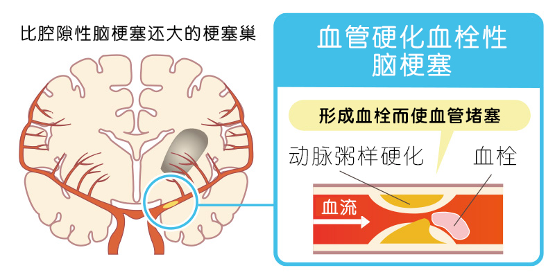 动脉硬化性脑梗死