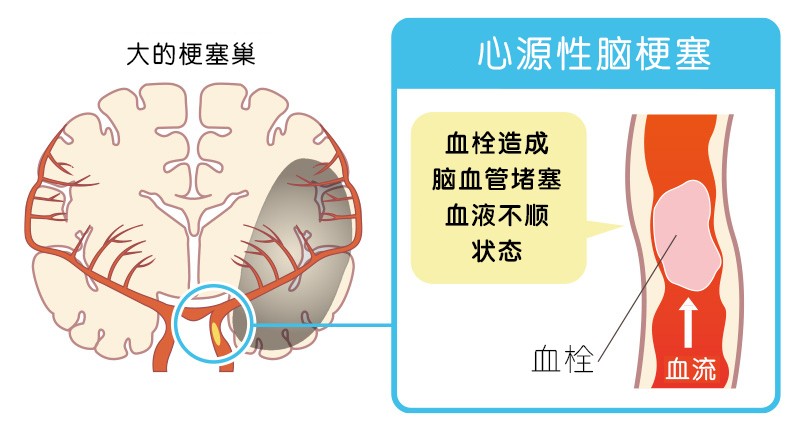 心源性脑梗塞