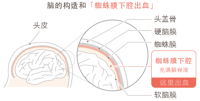 蛛网膜下腔出血是指软脑膜和蛛网膜之间的蛛网膜下腔出血。