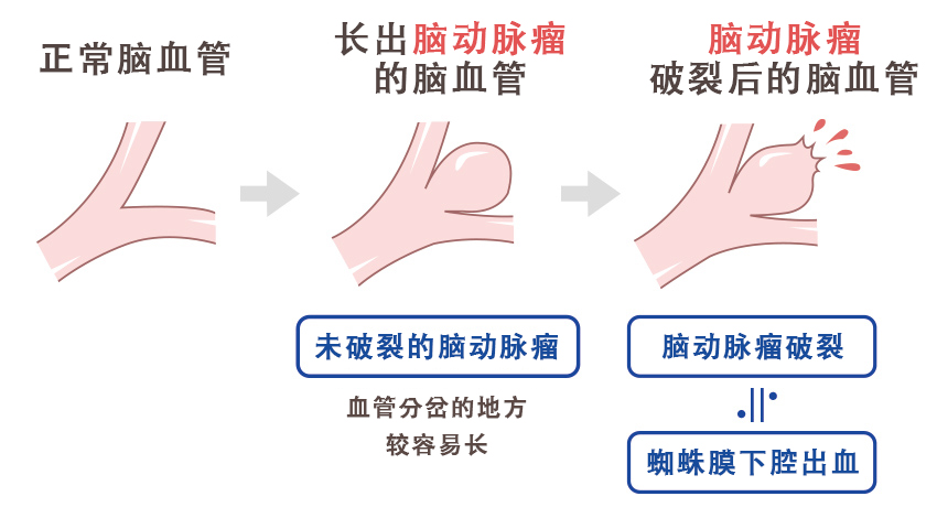 由脑动脉瘤破裂引起的蛛网膜下腔出血