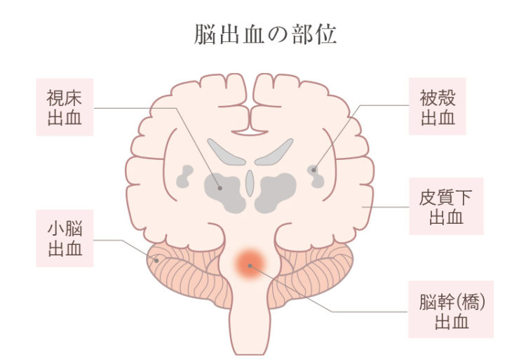 被殻出血とは?